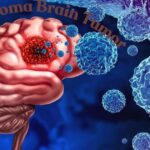 Glioblastoma Brain Tumor