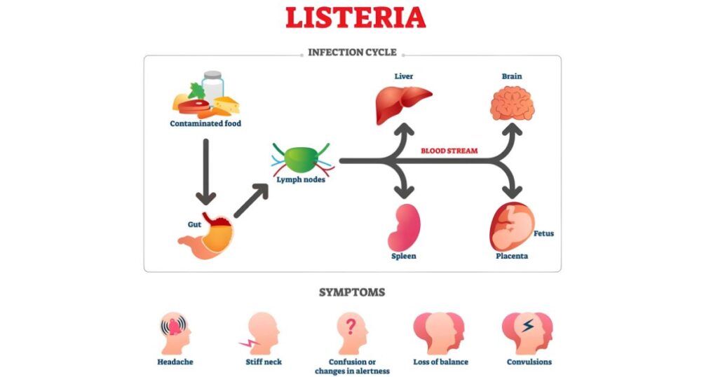 Listeriosis Symptoms: